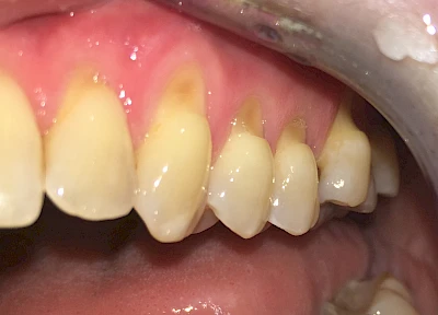 Beispiele: Keilförmiger Defekt