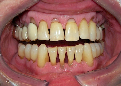 Beispiele: Keilförmiger Defekt