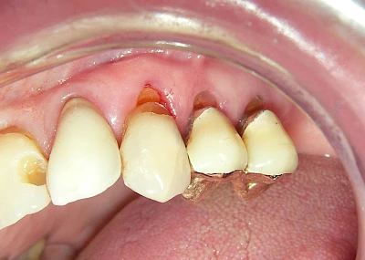 Beispiele: Keilförmiger Defekt