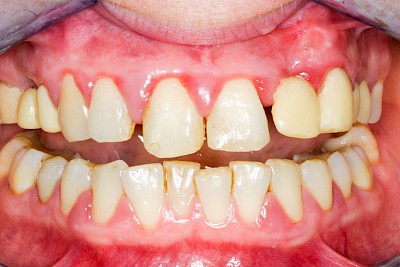 Beispiele: Gingivitis