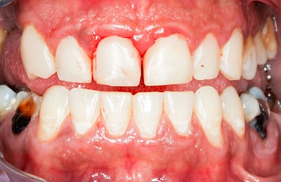 Beispiele: Gingivitis