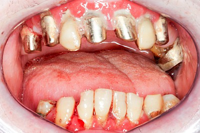 Beispiele: Gingivitis