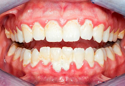 Beispiele: Gingivitis