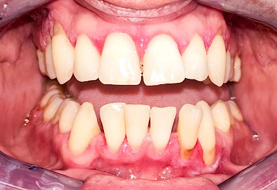 Beispiele: Gingivitis