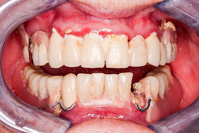 Beispiele: Gingivitis