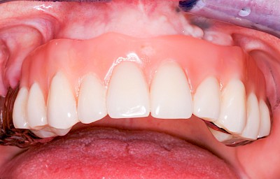 Beispiele: Gingivitis