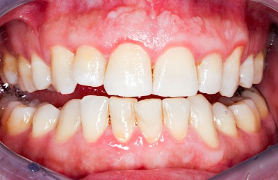 Beispiele: Gingivitis