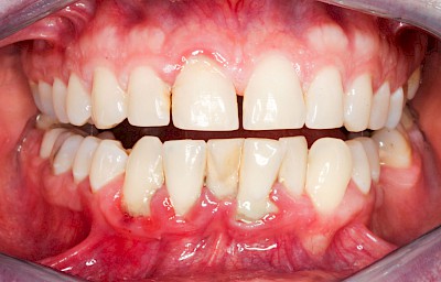 Beispiele: Gingivitis