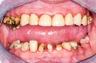 Beispiele: Gingivitis