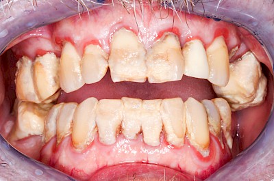 Beispiele: Gingivitis