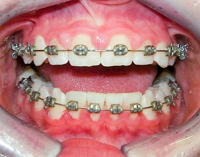 Beispiele: Gingivitis