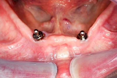 Beispiele: Peri-Implantitis