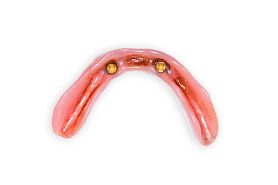 Beispiele: Peri-Implantitis