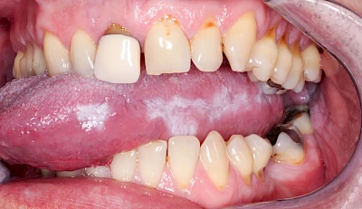 Beispiele: Leukoplakie, Erythroplakie