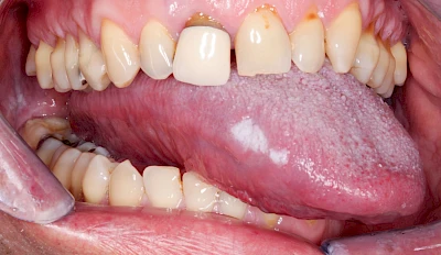 Beispiele: Leukoplakie, Erythroplakie