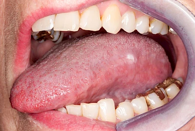 Beispiele: Leukoplakie, Erythroplakie