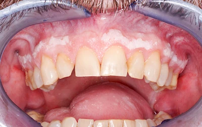 Beispiele: Leukoplakie, Erythroplakie