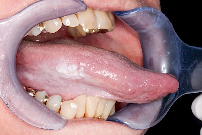 Beispiele: Leukoplakie, Erythroplakie