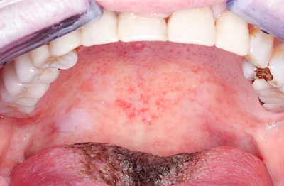 Beispiele: Leukoplakie, Erythroplakie