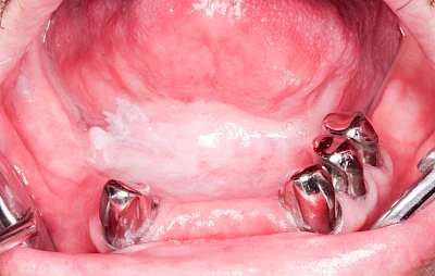 Beispiele: Leukoplakie, Erythroplakie