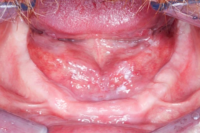 Beispiele: Leukoplakie, Erythroplakie