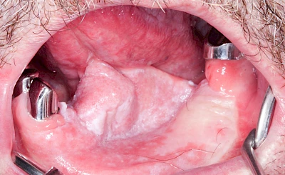 Beispiele: Leukoplakie, Erythroplakie