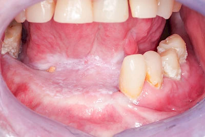 Beispiele: Leukoplakie, Erythroplakie