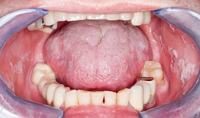 Beispiele: Leukoplakie, Erythroplakie