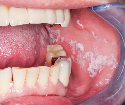 Beispiele: Leukoplakie, Erythroplakie