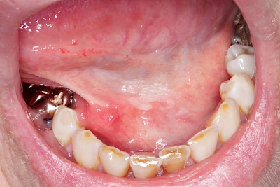 Beispiele: Leukoplakie, Erythroplakie