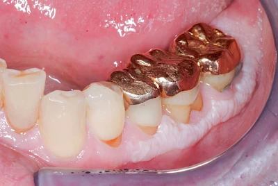 Beispiele: Leukoplakie, Erythroplakie