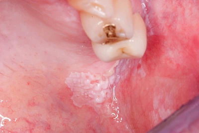 Beispiele: Leukoplakie, Erythroplakie
