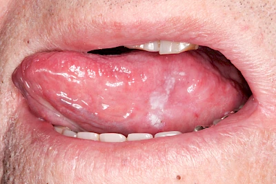Beispiele: Leukoplakie, Erythroplakie