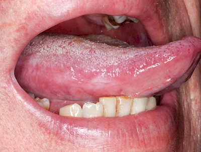 Beispiele: Leukoplakie, Erythroplakie