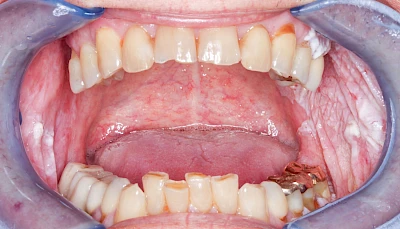 Beispiele: Leukoplakie, Erythroplakie