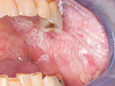 Beispiele: Leukoplakie, Erythroplakie