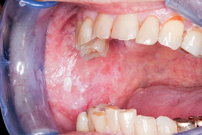Beispiele: Leukoplakie, Erythroplakie