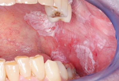 Beispiele: Leukoplakie, Erythroplakie