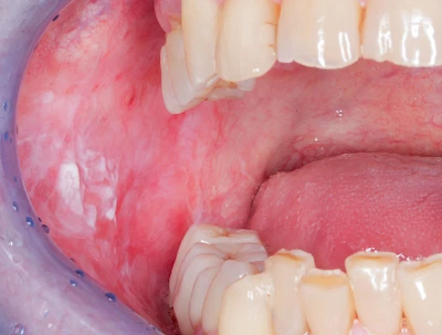 Beispiele: Leukoplakie, Erythroplakie