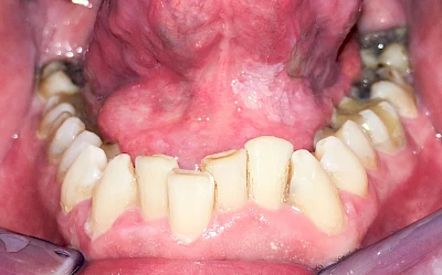 Beispiele: Leukoplakie, Erythroplakie