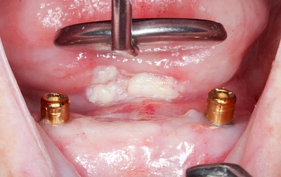 Beispiele: Leukoplakie, Erythroplakie