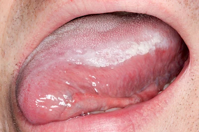 Beispiele: Leukoplakie, Erythroplakie