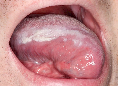 Beispiele: Leukoplakie, Erythroplakie