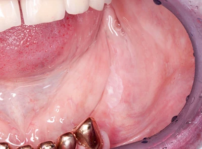 Beispiele: Leukoplakie, Erythroplakie