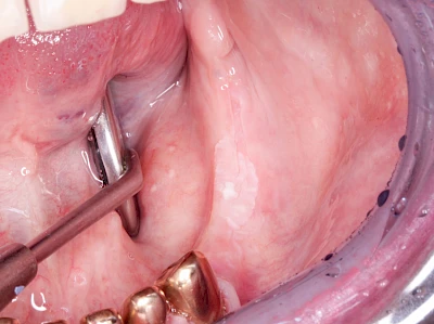Beispiele: Leukoplakie, Erythroplakie