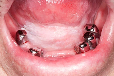 Beispiele: Leukoplakie, Erythroplakie