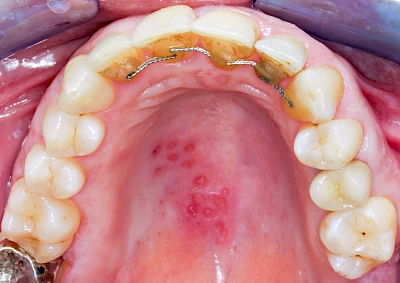 Beispiele: Herpes-Ausschlag