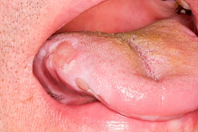 Beispiele: Einbiss & Bluterguss