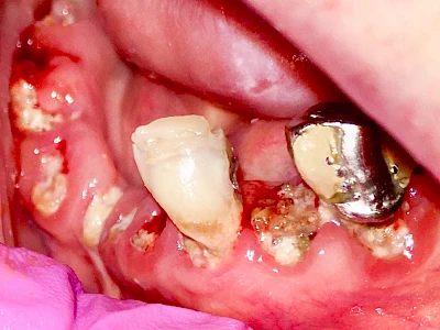 Beispiele: Einbiss & Bluterguss