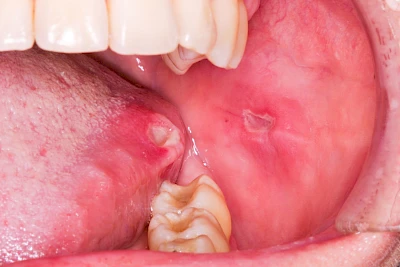 Beispiele: Einbiss & Bluterguss